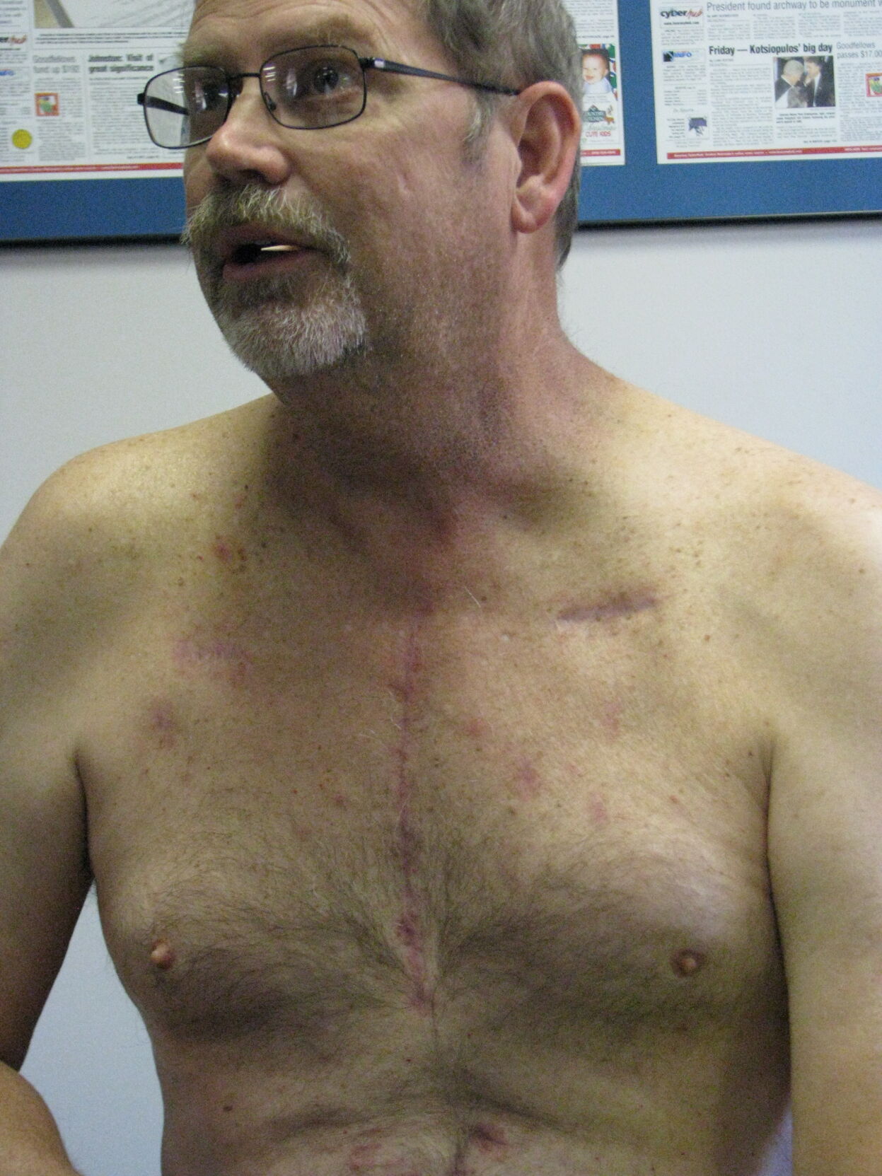 Roger's Scar